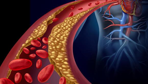 La enfermedad cardiovascular, que puede provocar infarto de miocardio o ictus, se produce debido a la formación de placas de ateroma en las arterías, un proceso llamado aterosclerosis. (Foto: Difusión)