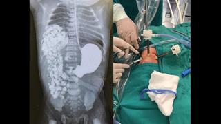 Villa El Salvador: médicos salvan vida de recién nacido que tenía intestino alojado en el tórax