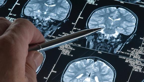 Expertos alentados por datos preliminares de fármaco contra el Alzheimer