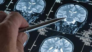 Pruebas preliminares de fármaco contra el Alzheimer muestra datos alentadores, dicen expertos