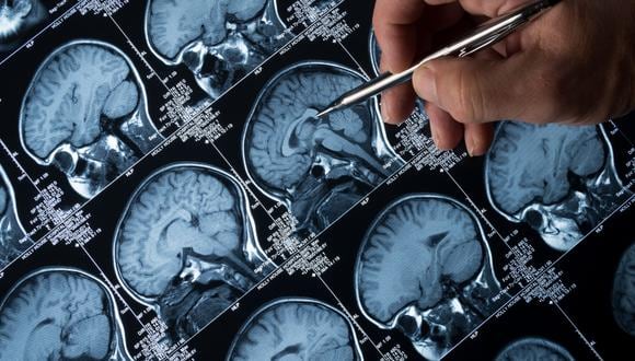 Los resultados del ensayo, que publica la revista ‘JAMA Neurology’, se validaron en cerca de 900 participantes de tres cohortes dedicadas a la investigación en prevención del Alzheimer. (Foto: iStock)