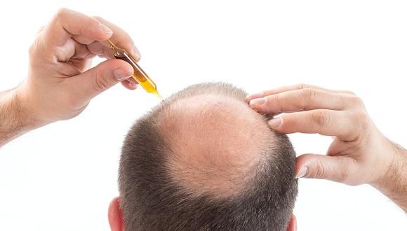 Los tratamientos anteriores para la alopecia incluían medicamentos tópicos u orales, pero estos se han considerado experimentales y no se aprobó ninguno. (Foto: Getty)