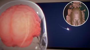 Neuralink implanta chip cerebral en humano: últimos avances de Elon Musk