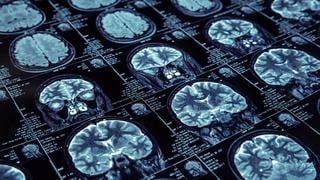 Fracaso de estudios sobre Alzheimer sacude mercado farmacéutico