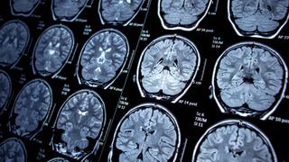 El COVID puede encoger el cerebro de los pacientes