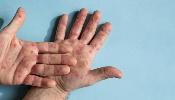 La enfermedad suele provocar fiebre, inflamación de los ganglios linfáticos y erupciones cutáneas. (Foto referencial de iStock)