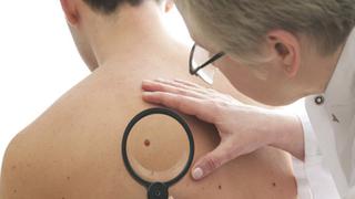 Vacunas de Moderna y Merck retrasan la reaparición del cáncer de piel mortal