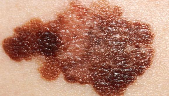 Los melanomas tienen tratamientos y pronósticos diferentes, una cuestión que es fundamental para poder comprender estas patologías. (Foto: Wikimedia)