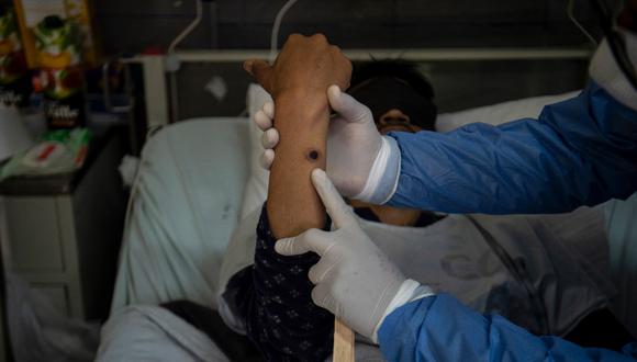 Los casos de viruela del mono en el Perú superaron el millar y se encuentran reportados en 15 regiones. (Foto: AFP)