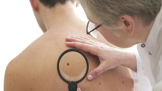 Merck y Moderna trabajan en vacuna contra el cáncer de piel