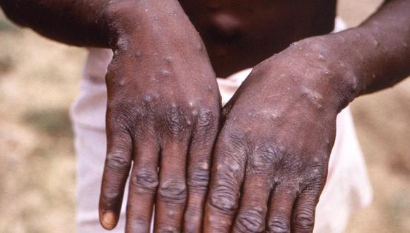 La viruela del mono afecta la piel, como en este paciente de África (Foto: Getty Images)