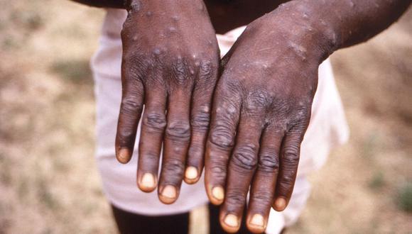 Imagen de 1997 durante una investigación sobre un brote de viruela del simio en el Congo. Un paciente muestra sus manos ante la erupción característica durante su etapa de recuperación (Foto: Brian W.J. Mahy / Centros para el Control y la Prevención de Enfermedades / AFP)