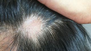 COVID | Sepa qué causa y cómo tratar la caída del cabello que afecta a uno de cada cuatro infectados