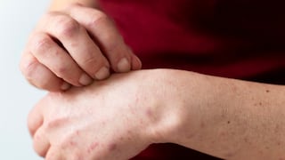 Sarampión en Perú: ¿Cuáles son las regiones declaradas en emergencia por esa enfermedad?