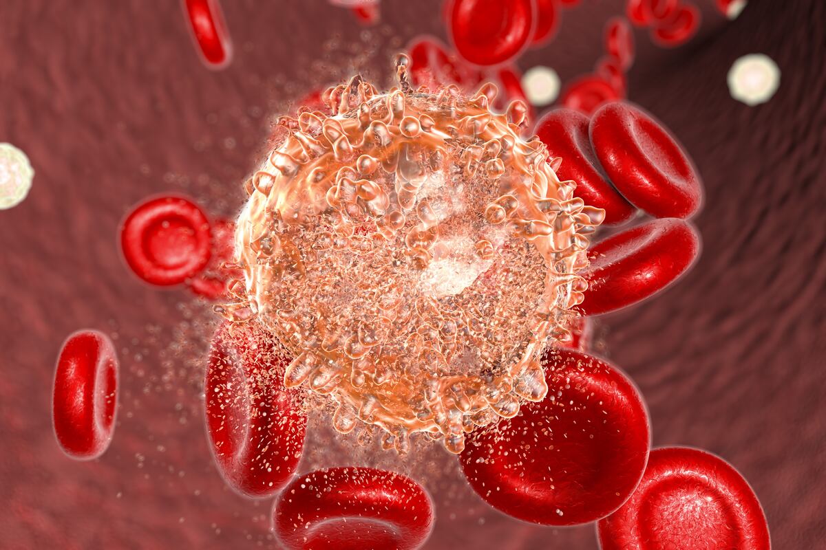 La leucemia es una neoplasia de las células progenitoras hematopoyéticas, que son las que dan origen a la sangre. (Imagen: Shutterstock)