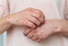 Casos de sarampión se quintuplican en América durante el primer trimestre de 2025