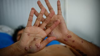 El mpox “no es el nuevo covid”, según la OMS
