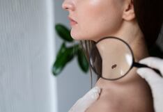 Perú: cerca de 10 mil personas anualmente son detectadas con cáncer de piel