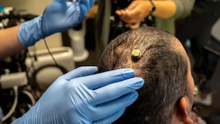 Magia o rechazo, dos experiencias opuestas con un implante cerebral