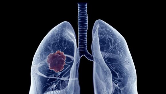 Los investigadores han logrado ahora combinar 49 conjuntos de datos pulmonares procedentes de casi 40 estudios distintos. (Foto: En difusión)