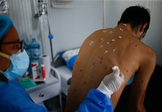 Viruela del mono: de qué trata esta enfermedad y otras interrogantes