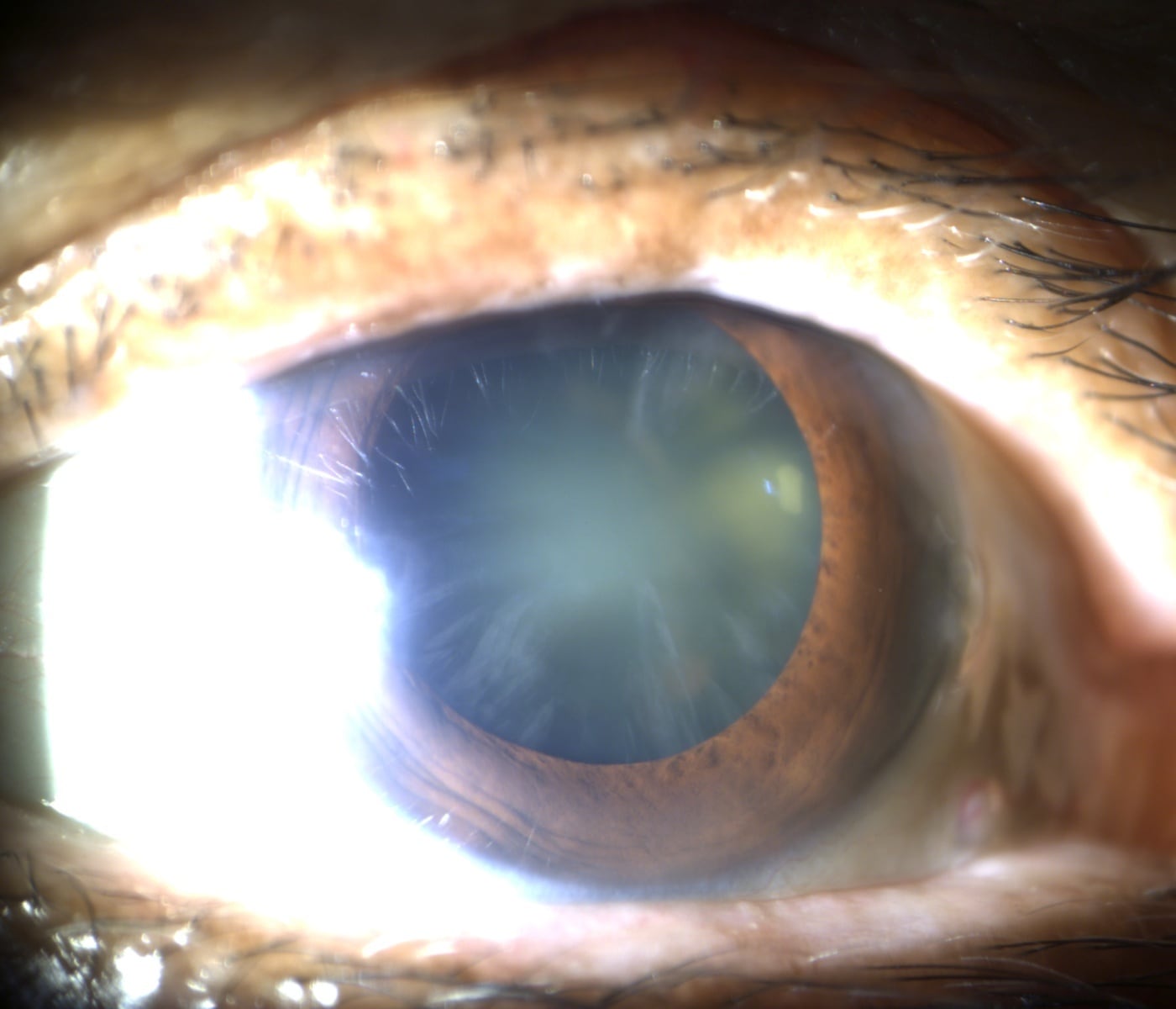 La visión borrosa, la pérdida de nitidez y la dificultad para reconocer rostros pueden ser señales de catarata.