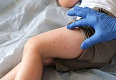 Minsa emitió alerta epidemiológica por riesgo de contagio de sarampión: ¿qué implica?