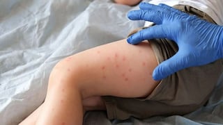 Minsa emitió alerta epidemiológica por riesgo de contagio de sarampión: ¿qué implica?