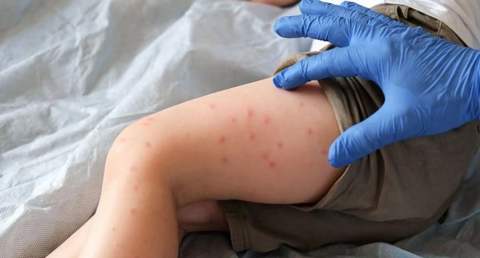 Minsa emite Alerta Epidemiológica ante transmisión comunitaria y riesgo de diseminación de sarampión en el Perú