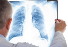 Hipertensión arterial pulmonar: Nueve de cada diez pacientes serían mujeres