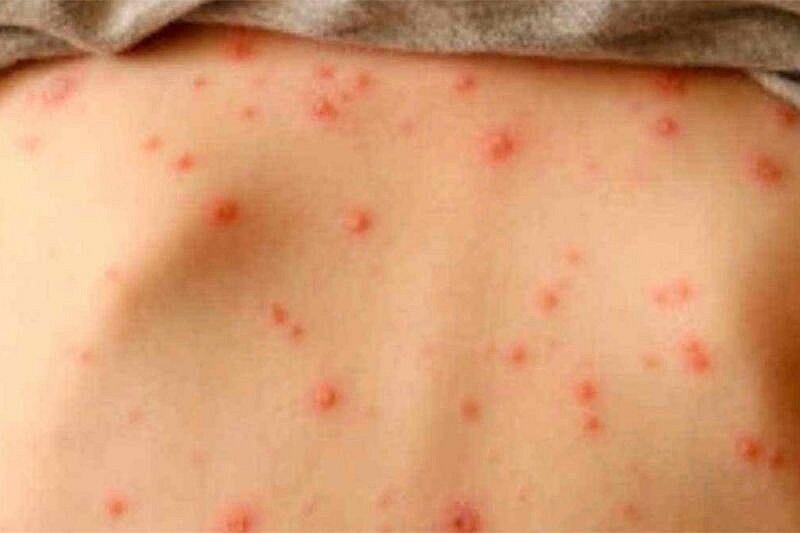 La transmisión del virus del sarampión es peligrosa por lo que se considera que es más contagiosa que el COVID-19.