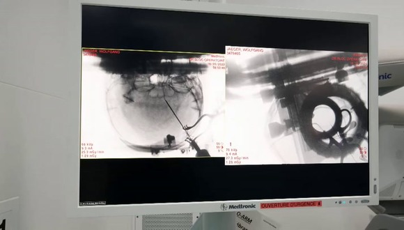 Tratamiento suizo permite caminar a pacientes con lesión de médula espinal