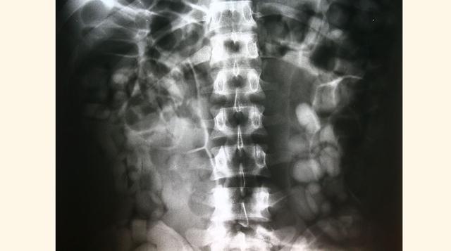 12 Radiografías. Contienen metales que no deben arrojarse. Además, alguno de ellos, como la plata, tienen valor y pueden recuperarse. También se recupera el plástico que lleva. El resto se incinera. (Foto:Perú21)